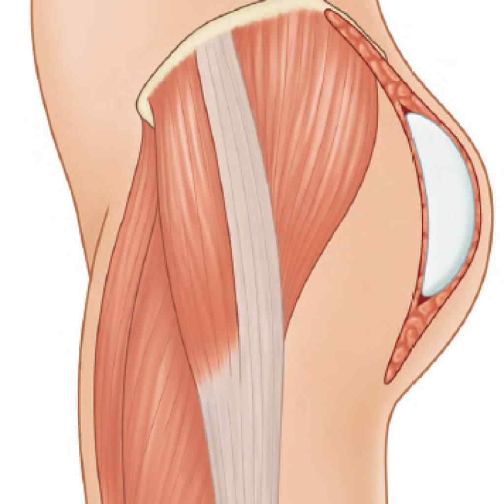 plano de implante gluteo.jpg
