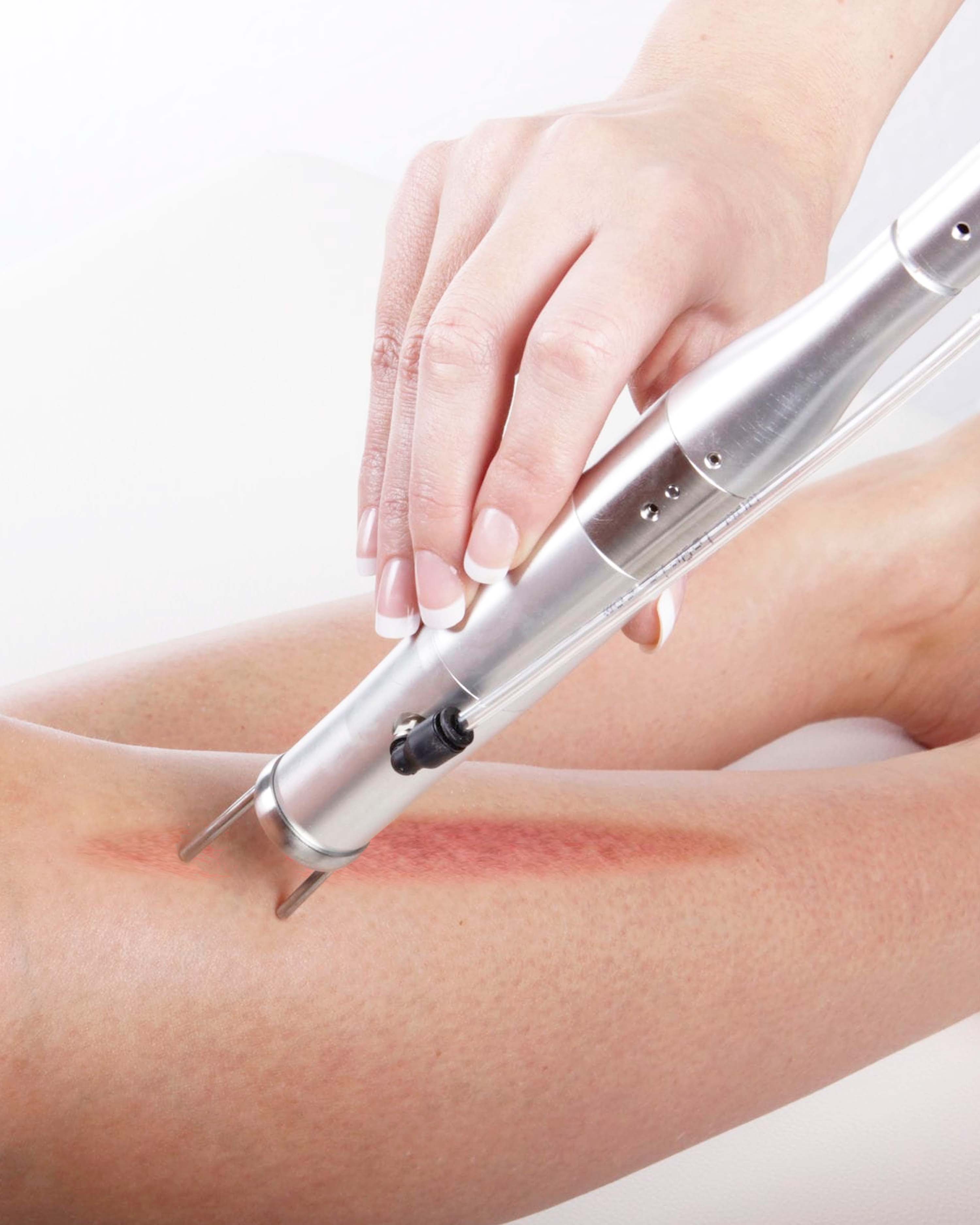 varices con laser.jpg